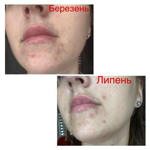 Серум з азелаїновою кислотою Theramid AZID 15% Azelaic Acid Treatment photo review