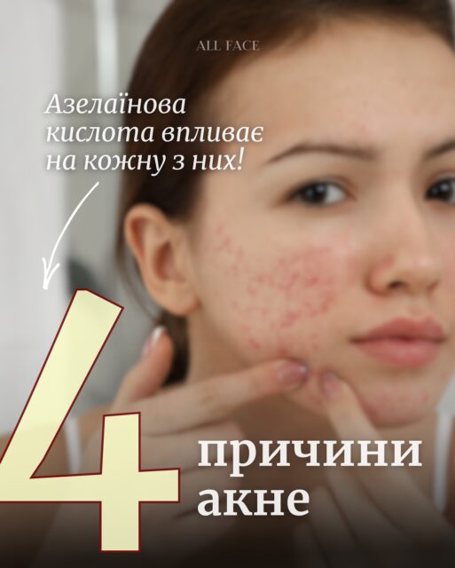 ЗА ЩО МИ ОБОЖНЮЄМО АЗЕЛАЇНОВУ КИСЛОТУ? 👀 

Спойлер: є за що! Гортайте, щоб дізнатися та… закохатися 🤍

Азелаїнова кислота — актив, який не кричить, але працює.
Для тих, хто цінує результат без стресу для шкіри 🙌🏻

🧴 Оберіть свою формулу на all-face.com.ua!