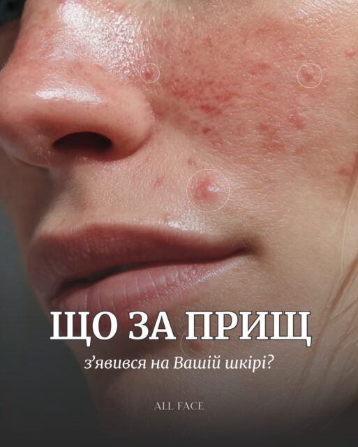 Шкіра може «видавати сюрпризи» по-різному: чорні цятки, комедони, поодинокі запалення чи прояви розацеа.
І для кожного випадку потрібна своя тактика догляду 🧩

У цій каруселі ми зібрали прості та зрозумілі алгоритми, щоб вам було легше розібратися, що робити саме з вашими висипаннями. Зберігайте, щоб не загубити 💌

Напишіть у коментарях, з чим стикається ваша шкіра — підкажемо, які засоби справді працюють для Вашого випадку. Консультація безкоштовна 🤍