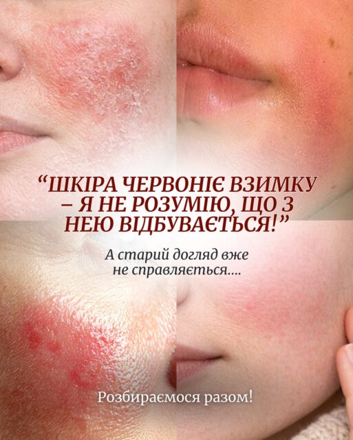 А ЯКЩО ЦЕ НЕ ПРОСТО ЧУТЛИВІСТЬ? 😱

Свербіж? Лущення? Чіткі межі почервоніння?
Можливо, це не реактивність шкіри, а холодовий дерматит ❄️

Як відрізнити ці стани та не нашкодити доглядом —
гортай слайди 👉🏻

📌 Зберігай, щоб не загубити взимку!