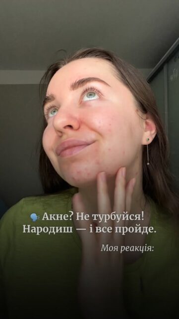 І ЦЕ ПРАЦЮЄ! 🤯

Але точно не завжди. Бо акне — це не “просто висипання”, які минають самі по собі ‼️

Це складний стан шкіри, фактично захворювання, на яке впливають один або кілька чинників:
• гормональний фон
• робота сальних залоз
• генетика
• запалення
• догляд (або його відсутність)
• спосіб життя та стрес

Іноді причина дійсно гормональна. Під час вагітності й після пологів гормональний фон жінки змінюється, тому багато хто помічає покращення шкіри, волосся чи нігтів. Таке БУВАЄ 🙏

Але це не означає, що потрібно:
💔 терпіти акне роками
💔 чекати “того самого моменту”
💔 або бігти народжувати, щоб вилікувати шкіру 🙂

👉 Найкращий вихід ЗАРАЗ — консультація.
Ми проаналізуємо стан вашої шкіри, поточний догляд і підкажемо, як з цим працювати — БЕЗКОШТОВНО.

*За потреби чесно скеруємо до профільних спеціалістів 💛

Не відкладайте догляд “на потім”. Напишіть у коментарях — ми поруч і готові допомогти 🫂