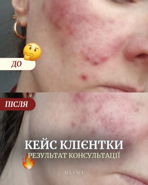 Цей результат — ще один доказ, що правильний догляд дає результат ✨

Але цей шлях не завжди швидкий — він потребує системності, терпіння та правильного підходу. Наша клієнтка разом із командою All Face крок за кроком рухається до здорової, спокійної шкіри 😍

Попереду ще робота, але вже зараз видно, як змінюється стан шкіри при грамотному догляді 💛

Ми підберемо догляд саме під ваш запит і стан шкіри — без навмання та перевантаження 🙌🏻

Залишайте коментар або натискайте «Чат» на сайті — і ми допоможемо розібратись. Пояснимо, підтримаємо й будемо поруч на кожному етапі 🤍