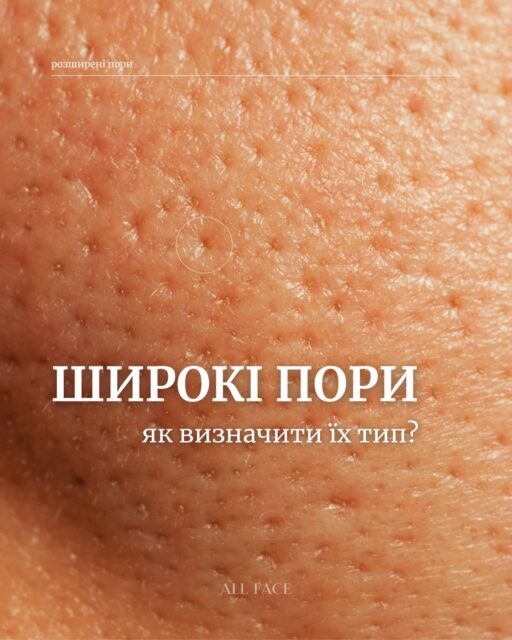 Пори є у всіх — але виглядають по-різному ✨
І догляд для них теж має бути різний!

Важливо не просто «звузити пори», а зрозуміти їх тип і причину 👌

👉 Найкраще рішення — фахова консультація.
Ми аналізуємо стан шкіри, твій догляд і пояснюємо, як реально покращити ситуацію.

Консультація в ALL FACE — безкоштовна 💌