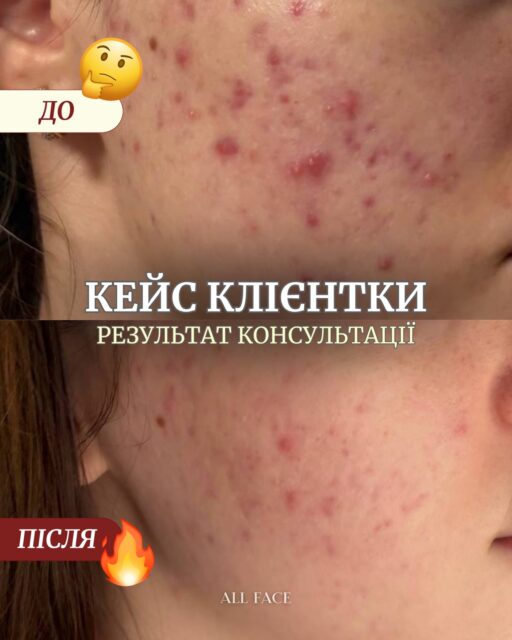 Цей кейс — ще одне підтвердження, що шкіра подякує вам за правильно підібраний догляд 🩵

Постійні запалення, болючі підшкірні висипання та сліди постакне — це не той випадок, коли варто хаотично купувати засоби. 

У цьому кейсі ми професійно скоригували догляд клієнтки — і вже бачимо результат: 
менше запалень, рідші нові висипання, сліди постакне поступово світлішають, а тон шкіри виглядає рівнішим ✨

Наша мета — не просто запропонувати вам повністю новий догляд. 
Під час консультації ми аналізуємо, які засоби вже є у вашій рутині, що можна залишити, а що справді потрібно замінити

Впізнали хоча б один із цих запитів? Це сигнал, що варто завершити експерименти. 

Звертайтесь на безкоштовну консультацію All Face

Залишайте коментар «консультація» під дописом — і ми зв’яжемось з вами в Direct 🤍