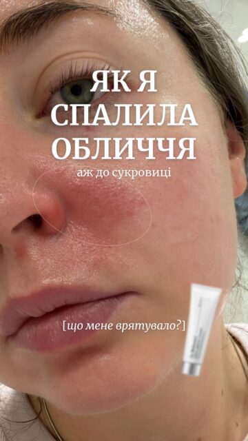 Як Настя спалила шкіру? І що допомогло їй відновитись?

У цьому відео ділимось історією: що сталося зі шкірою, чому ситуація виявилась серйознішою, ніж звичайне подразнення, і який SOS-засіб допоміг на етапі відновлення.

Подразнення, печіння, лущення чи пошкодження бар’єра можна отримати як після інтенсивних косметологічних процедур, так і в домашньому догляді — особливо після кислот, ретинолу або невдалого поєднання засобів.

Тому SOS-засіб краще мати під рукою. Коли шкіра подразнена, пече або лущиться, важливо не експериментувати, а одразу підтримати її відновлення.

Напишіть у Direct «хочу посилання», і ми надішлемо посилання на засіб 🤍