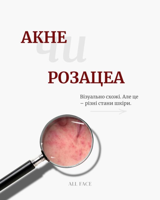 Акне чи папуло-пустульозна форма розацеа? 🤔

На перший погляд вони можуть виглядати дуже схоже: почервоніння, запальні висипання, чутливість. Але догляд у цих станів відрізняється.

При акне основна увага — контролю себуму та роботі з комедонами. При розацеа — відновленню захисного бар’єра, зменшенню подразнення та щоденному захисту шкіри від сонця 👀

Гортайте карусель, щоб дізнатися, як відрізнити ці стани та який базовий догляд потрібен у кожному випадку.

А якщо ви все ще не впевнені, чи це акне, чи розацеа, — напишіть нам у Direct. Допоможемо розібратися та підібрати засоби саме під ваші потреби 🤍