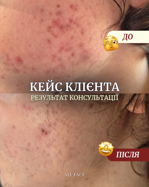 Цей кейс — ще одне нагадування, що правильно підібраний догляд справді працює 🙏

Ми не просто замінили засоби, а побудували комплексну схему догляду з урахуванням стану шкіри. Уже на цьому етапі запалень стало менше, а шкіра виглядає спокійнішою.

Робота ще триває: попереду корекція постакне та досягнення стійкої ремісії.

Хочете розібратися, чого не вистачає саме вашому догляду? Напишіть «консультація» у коментарях — і ми зв’яжемося з вами в Direct 🤍