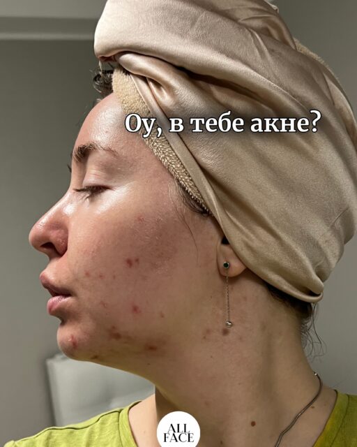 Моя боротьба з акне — це роки. Роки помилок, пошуку та власного досвіду.

Сьогодні моя шкіра перебуває в ремісії. І є лише 3 основні пункти, на яких вона тримається:

• харчування
• догляд: якісна база + активи
• активність. 
ВСЕ!

Звісно, акне — це багатофакторний стан, і універсального рішення не існує. Але саме ці звички стали фундаментом, який допомагає мені підтримувати шкіру в ремісії.

Можливо, сьогодні саме той день, коли і тобі варто зробити перший крок? 🤍