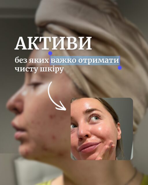 Понад 16 років я живу з проблемною шкірою 🫠

Акне, комедони, висипи, реакції буквально на все — і постійний пошук того, що реально допомагає тримати шкіру в ремісії.

За цей час я зрозуміла: чиста шкіра для мене — це на 80% правильно підібраний догляд. І є активи, без яких мені було б дуже важко підтримувати той результат, який я маю зараз.

У цій каруселі — все про них!👀
Ретиноїди, азелаїнова кислота, BHA, бензоїл пероксид, лінолева кислота та ніацинамід.

Розповідаю, як вони працюють і яке місце реально займають у моєму догляді. Гортайте ➡️