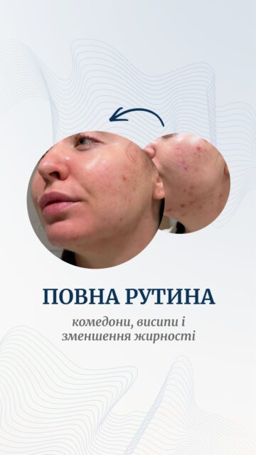 КОМЕДОНИ, ЖИРНА ШКІРА, ВИСИПИ?

Тоді ловіть рутину, яку хочеться не просто зберегти, але й повторити 👇

• Dr.Different 1st Cleanser
Гель для демакіяжу без олій. Розчиняє SPF і макіяж, але без відчуття жирної плівки. Особливо зайде, якщо гідрофільні олії вам ну зовсім не подобаються.

• Dr.Different Vitaacnal Trouble Cleansing Foam 
Пінка із саліциловою кислотою. Очищує пори, допомагає контролювати жирність і працювати з чорними цятками та висипаннями.

• Dr.Different VITAACNAL TX Night Cream
Ось тут починається найцікавіше 🔥 
Ретиналь 0,1% + LHA-кислота — дует, який працює з висипаннями, комедонами, нерівним рельєфом і надлишком себуму.

• Dr.Different 113 Moisturizer
Крем, який допомагає відновлювати шкіру, не перевантажуючи її. А лінолева кислота у складі додатково допомагає працювати з вʼязкістю себуму.

І все — 4 кроки догляду для жирної та проблемної шкіри.

Зберігайте, щоб не загубити, і підписуйтеся — попереду ще багато цікавих добірок 🤍