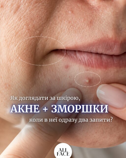 Акне не питає, скільки тобі років 🫠

Хороша новина: не обов’язково обирати, з чим працювати першим. Є актив, який допомагає боротися з висипаннями, покращувати текстуру шкіри та зменшувати помітність дрібних зморшок.

Знайомся з Dr.Different VITAACNAL TX Night Cream — нічним кремом із 0,1% ретиналю для шкіри, схильної до акне.

Що всередині?
▪️ 0,1% ретиналю — для роботи з висипаннями, текстурою та зморшками.
▪️ LHA — для відлущення.
▪️ Церамід NP, холестерин і лецитин — для підтримки захисного бар’єра.
▪️ Гліцерин і гіалуронат натрію — для зволоження.

20 г | арт. 82087 | 1 589 грн

Хочеш спробувати? Шукай крем на сайті ALL FACE або пиши нам у Директ — допоможемо розібратися, чи підійде він твоїй шкірі 🤍