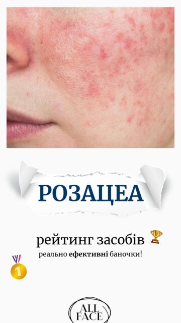 РОЗАЦЕА — ЯК ПІДТРИМАТИ ШКІРУ? 

Почервоніння, видимі судинки та висипання? Зібрали рейтинг із 5 засобів — від заспокійливого догляду до продуктів з активними компонентами👇

5️⃣ USOLAB Bio Intensive K Cream — підтримувальний догляд із вітаміном K для шкіри, схильної до почервоніння.
50 мл / 1 765 грн

4️⃣ CUSKIN Clean-Up Calming Intensive Cream — заспокійливий крем для чутливої шкіри, що потребує комфорту та підтримки бар’єра.
30 мл / 1 476 грн

🥉 Braderm Rosac Cream — крем з азелаїновою кислотою для шкіри з почервонінням і запальними проявами.
30 мл / 1 890 грн

🥈 Elegant Azelogy Gel — лікувальні засоби з азелаїновою кислотою для роботи з почервонінням і висипаннями.
10% / 30 г / 485 грн
14% / 30 г / 520 грн

🥇 Elegant ІВЕРЛІТ — засіб на основі івермектину для лікування папуло-пустульозної розацеа. Лише за призначенням спеціаліста ‼️
30 г / 910 грн

До 25 жовтня записуйтеся на безкоштовну консультацію в ALL FACE та отримуйте міцелярну воду Bioderma Sensibio 100 мл у подарунок 🎁 

Пишіть у Директ «КОНСУЛЬТАЦІЯ» — допоможемо розібратися з потребами шкіри та підібрати догляд.

Кількість місць і подарунків обмежена! 🫶