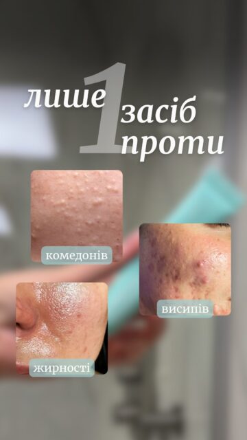Здається, ми знайшли НАЙКРАЩЕ для проблемної шкіри 🏆

Баночка, яка комплексно працює з висипами, комедонами та надмірною жирністю, допомагаючи покращити текстуру й вигляд шкіри.

Dr.Different VITAACNAL TX Night Cream — нічний крем із 0,1% ретиналю та LHA-кислотою.
▪️ретиналь сприяє оновленню шкіри та допомагає боротися з висипаннями, 
▪️LHA-кислота забезпечує м’яке відлущення й доповнює догляд за шкірою, схильною до акне.

Dr.Different VITAACNAL TX Night Cream
1 589 грн — 20 г 
Артикул: 82087

Давно шукали комплексний засіб для проблемної шкіри? Здається, це він! Пишіть нам у Direct — допоможемо з вибором 💌
