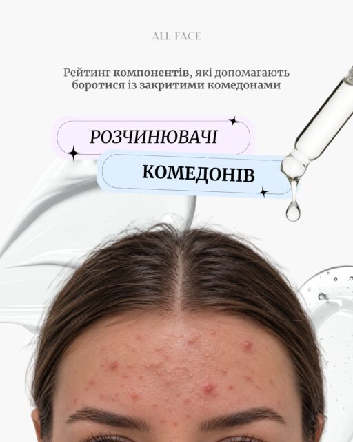 Комедони знову й знову повертаються, а текстура шкіри все ще нерівна? Розбираємося, що з цим робити 👉

Закриті комедони — це маленькі підшкірні горбики, які роблять шкіру нерівною на вигляд. Причини можуть бути різними: надмірне виділення себуму, накопичення ороговілих клітин, індивідуальна схильність та особливості догляду.

Що працює? 🏆
BHA-кислоти, лінолева кислота та інші активи, які можуть допомогти в роботі з комедонами. Але головне — не просто обрати популярний компонент, а підібрати догляд, який відповідатиме потребам саме вашої шкіри.

Не знаєте, з чого почати? Давайте розберемося разом 🫶

Записуйтеся на БЕЗКОШТОВНУ онлайн-консультацію в ALL FACE. Допоможемо визначити потреби вашої шкіри та підберемо персональну схему догляду — без хаотичних експериментів і зайвих покупок.

🎁 Цього тижня після онлайн-консультації ви отримаєте нічний серум Norden Mosse з BHA та цинком у подарунок!

Пропозиція діє до 01.11 включно. Кількість місць і подарунків обмежена.

Пишіть у Direct слово «КОНСУЛЬТАЦІЯ» — зробімо перший крок до догляду, який підходить саме вам 🤍