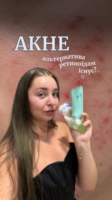 ПОБОРОТИ АКНЕ БЕЗ РЕТИНОЇДІВ — ЦЕ МОЖЛИВО?

Ретиноїди не всім підходять: іноді шкіра погано їх переносить, а під час вагітності їх рекомендують уникати. Але це не означає, що варіантів боротьби з акне більше немає! 🤍

Зібрали топ-5 активів, які можуть допомогти, якщо ретиноїди вам не підходять. Рейтинг — від менш до більш ефективних:

5️⃣ Ніацинамід — допомагає регулювати себум і підтримувати шкірний бар’єр.

4️⃣ Сірка — має антибактеріальні та кератолітичні властивості.

🥉 Саліцилова кислота (BHA) — допомагає очищувати пори та боротися з комедонами.

🥈 Азелаїнова кислота — працює із запаленнями, висипами та слідами постакне.

🥇 Бензоїл пероксид — один із найефективніших компонентів проти запальних висипів, який діє на бактерії, пов’язані з акне.

Хочете дізнатися, які засоби з цими активами обрати? Залишайте будь-який коментар — надішлемо в дірект посилання на всі засоби з відео 💌

А ще розповімо, як отримати нічний серум Norden Mosse з BHA та цинком у подарунок після онлайн-консультації в ALL FACE цього тижня 🎁