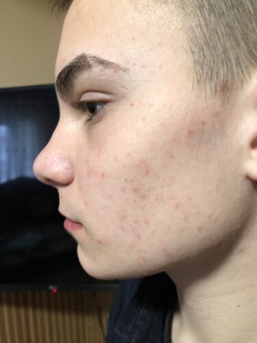 Ензимна пудра з чайним деревом Medi-Peel Micro Tea Powder Cleanser photo review