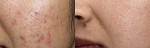 Крем для проблемної шкіри з 0.1% ретиналю Dr.Different VITAACNAL TX Night Cream photo review